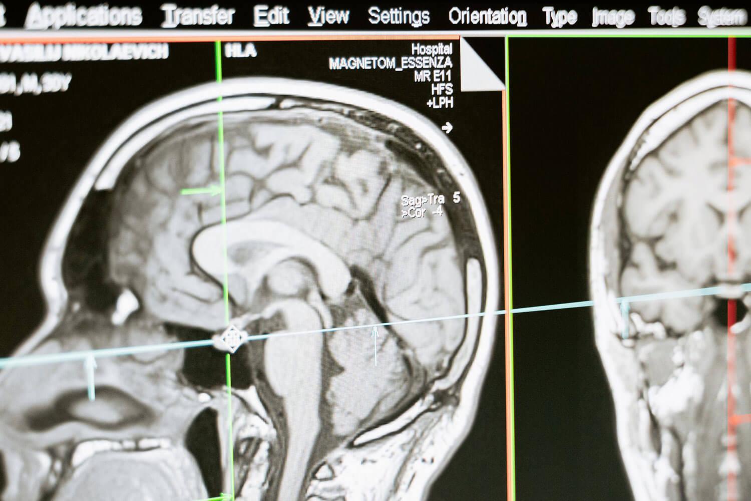 Exploring the Brain – How Head MRI Scans Can Uncover Hidden Neurological Conditions